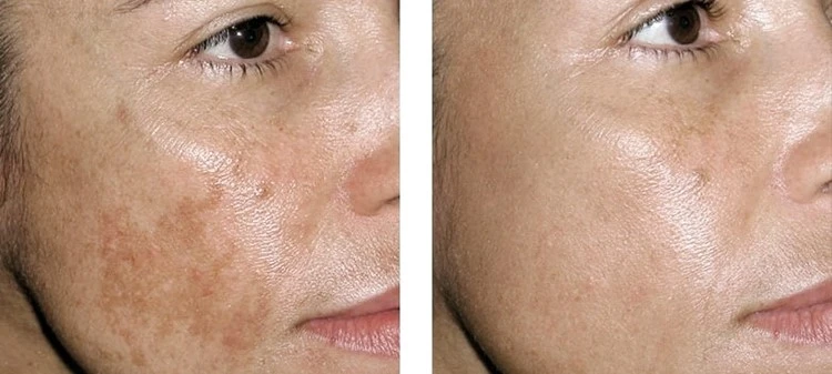 1927nm laser treatment Melasma 1927nm laser treatment Melasma