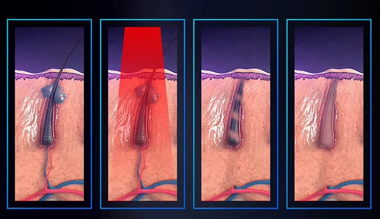 Diode Laser Hair Removal Professional Machine Diode Laser Hair Removal Professional Machine